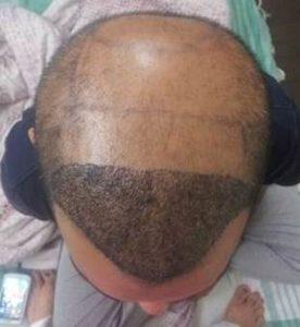 קו השתלה אחורי ליניארי