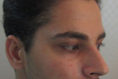בוצעה השתלת שיער הכוללת 2560 שתלים