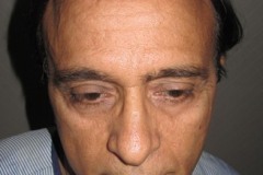 אחרי השתלת שיער מלפנים