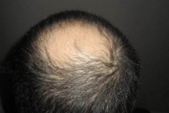 כתר לפני השתלת שיער מטופל אמריקאי