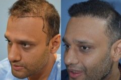 השתלת שיער לגבר