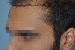 תיקון השתל שיער