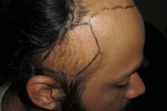 מטופל לפני השתלת שיער בעקבות Traction Alopecia
