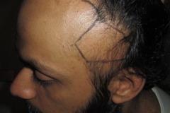 לפני השתלת שיער בעקבות Traction Alopecia