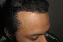 השתלת שיער למטופל אחרי Traction Alopecia
