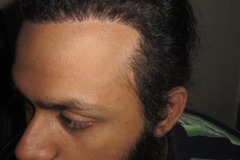 השתלת שיער למטופל אחרי Traction Alopecia לאחר 5 חודשים
