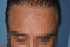 תיקון השתלת שיער עם שיער גוף