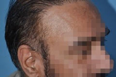 תיקון השתלת שיער